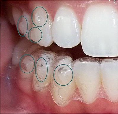 How Invisalign Attachments are placed? 